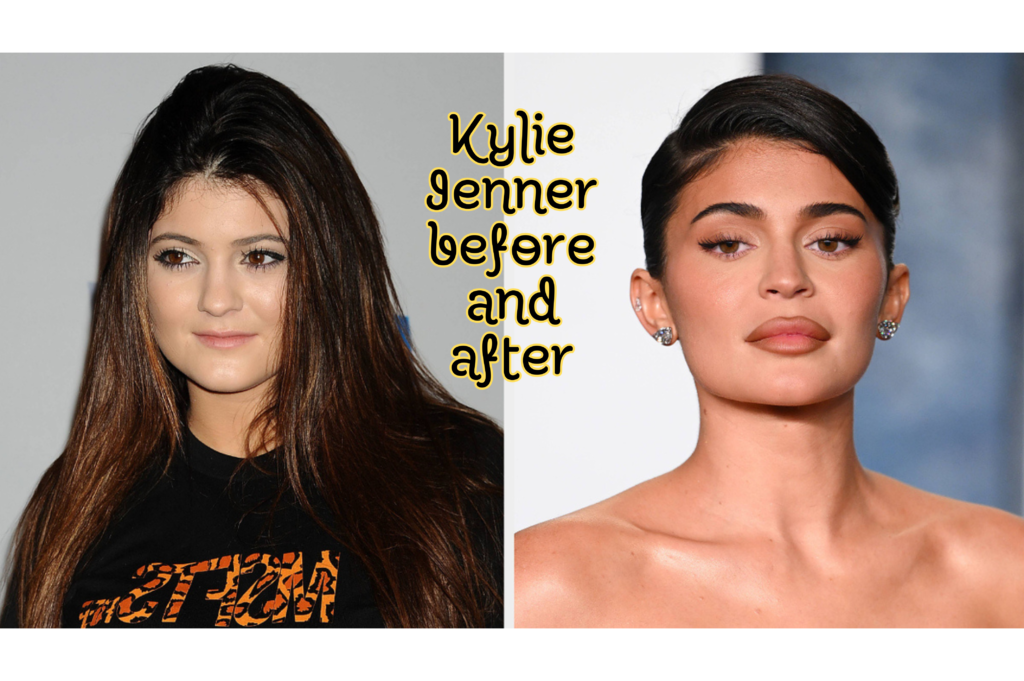 Kylie Jenner Before and After